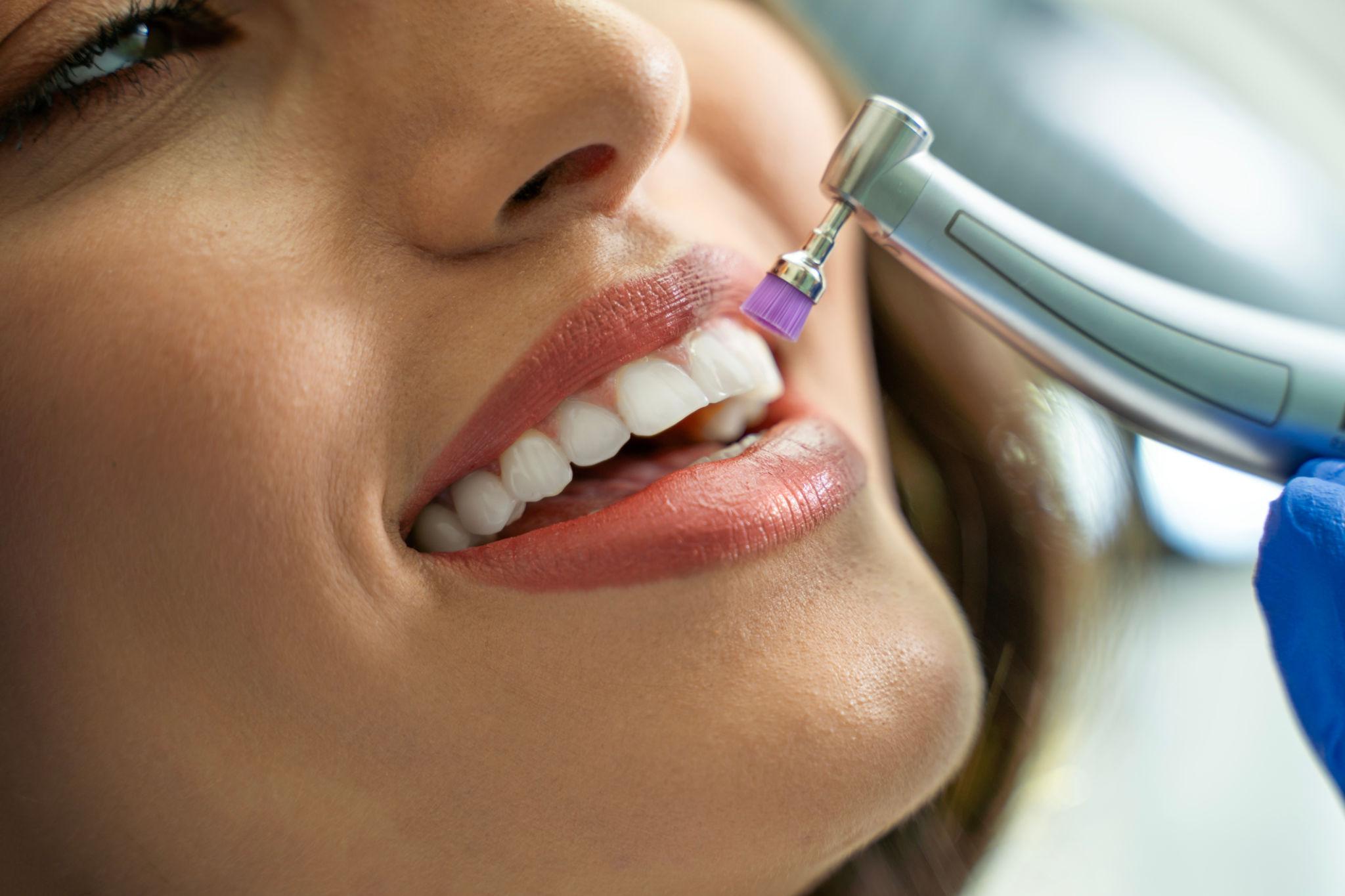 Teeth whitening and veneers care