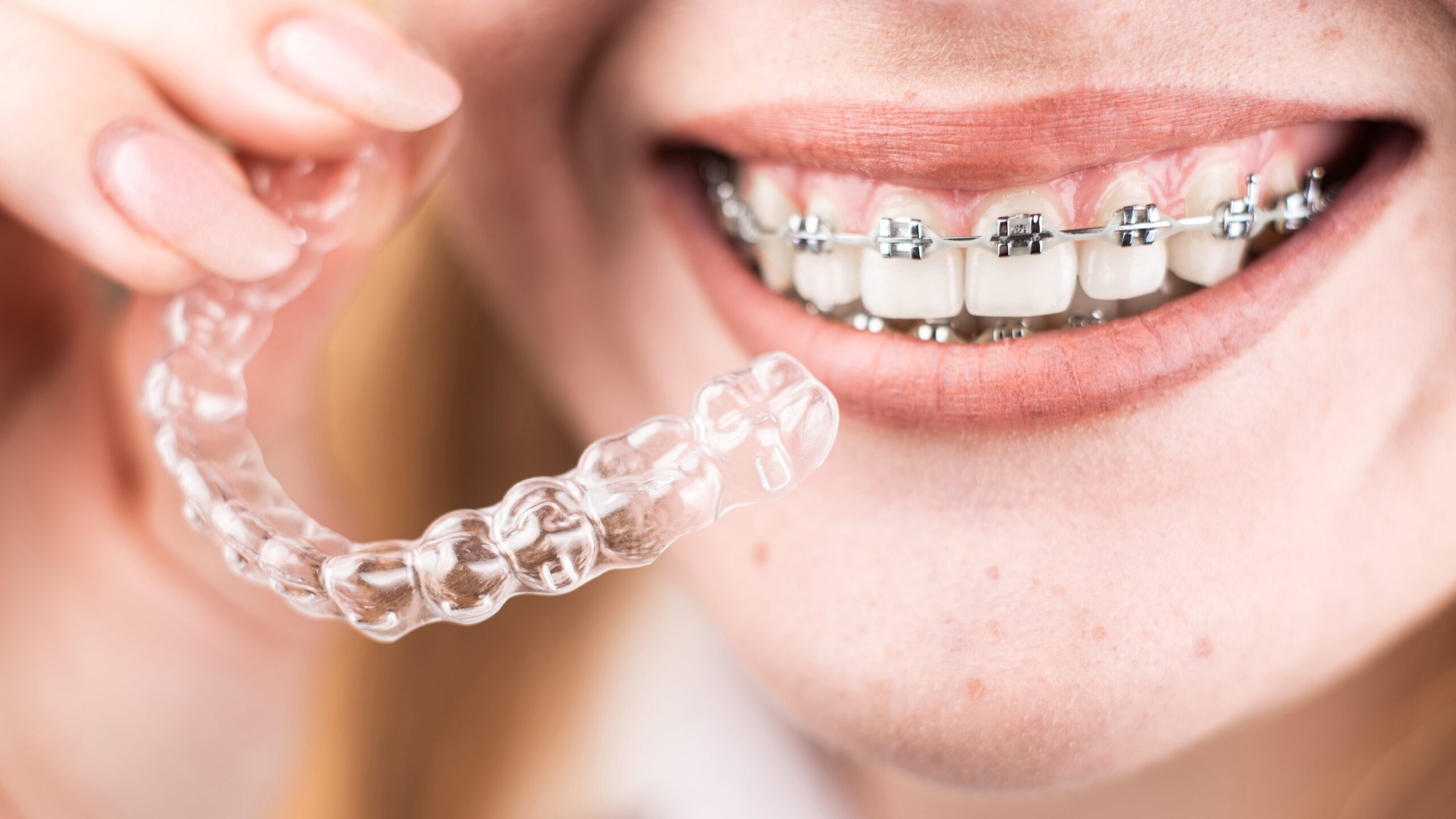 Orthodontic braces