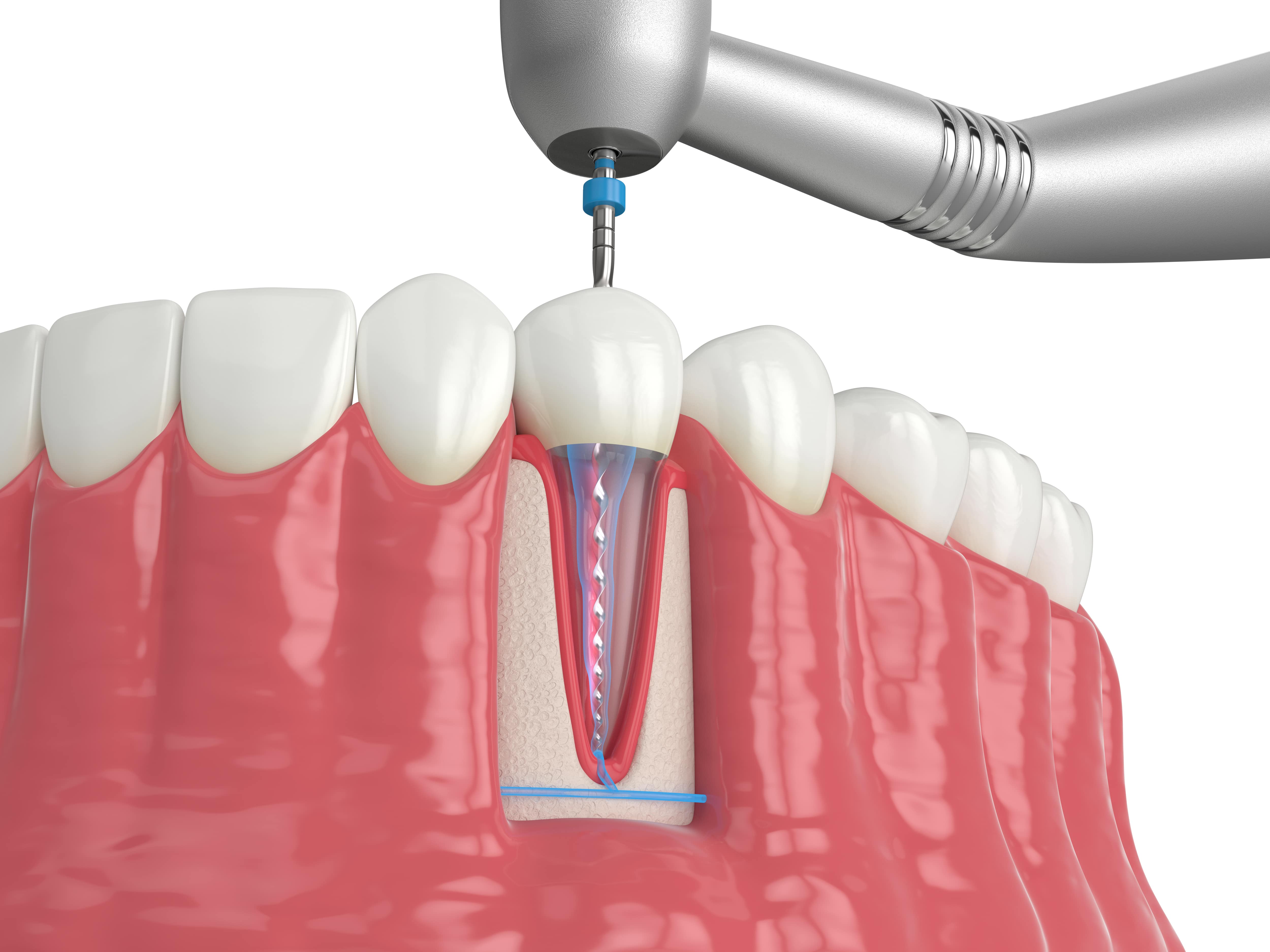 Root canal procedure