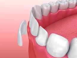 Smile after veneers treatment