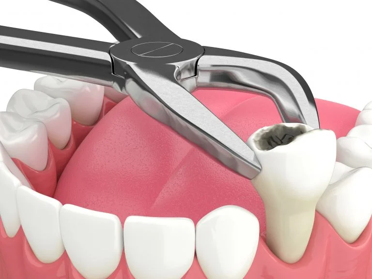 Tooth extraction treatment