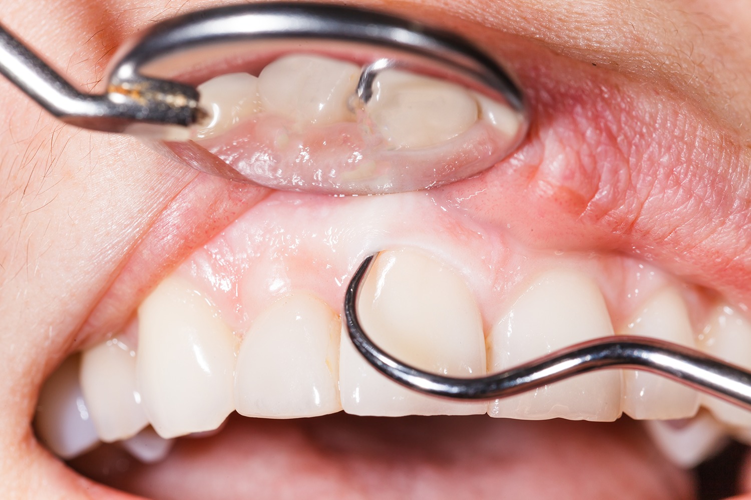 Gum treatment service at Whiteberry Dental Clinic