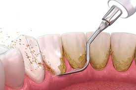 Professional gum treatment