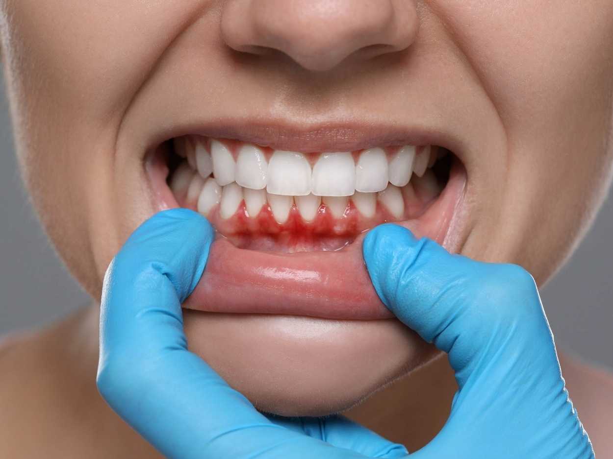 Gum evaluation