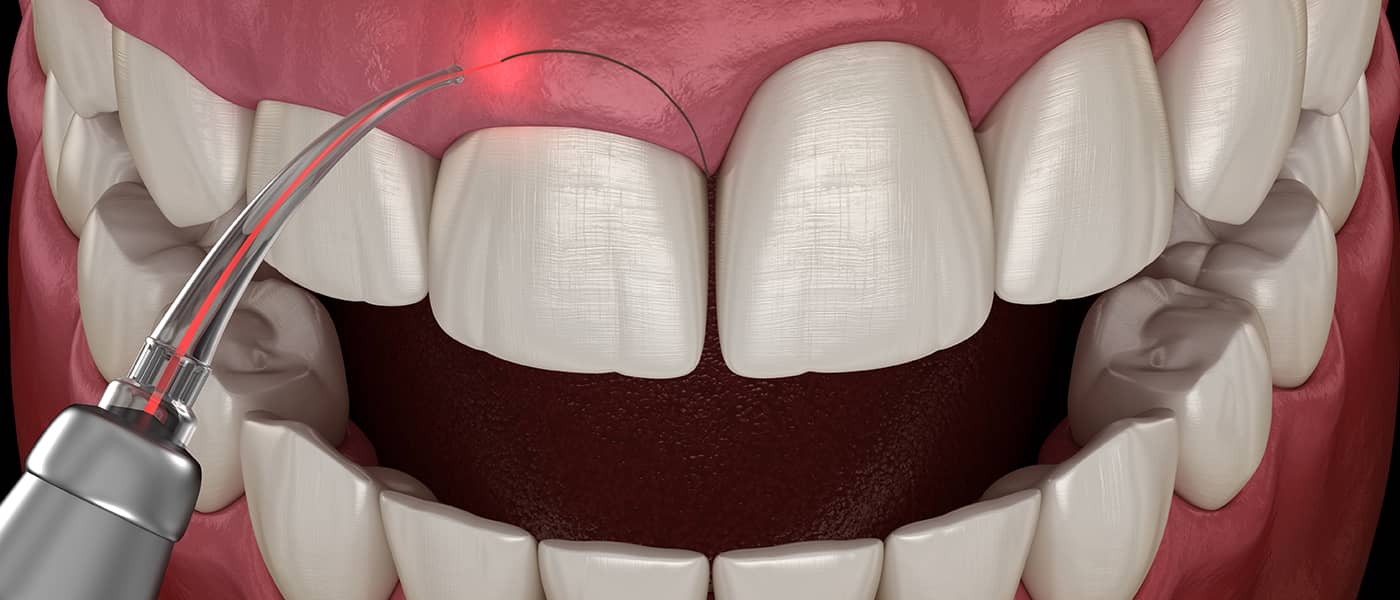 Healthy smile after gum care