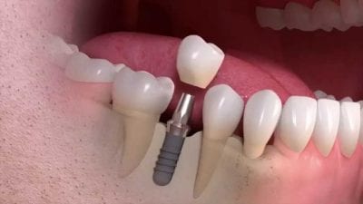 Implant placement illustration