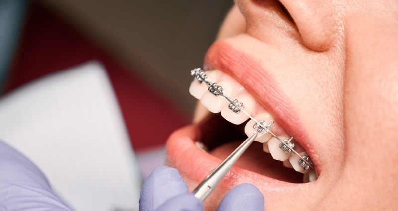 Orthodontic braces and aligner service at Whiteberry Dental Clinic