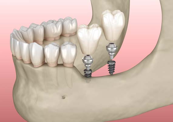 Recovered implant smile