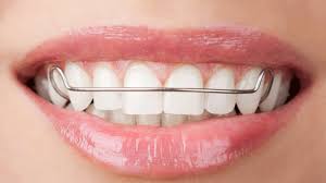 Aligned smile after orthodontics