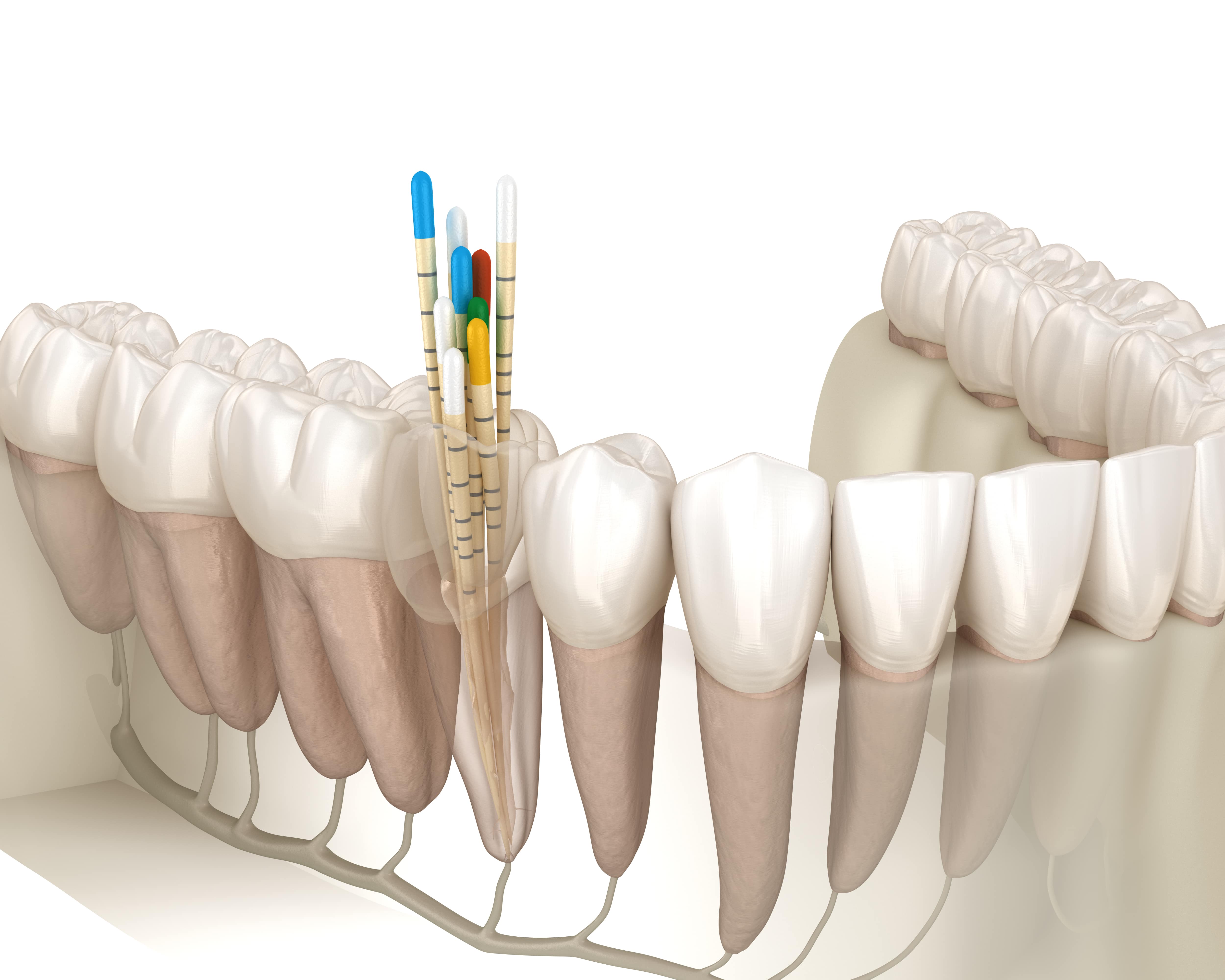 Restored tooth after root canal