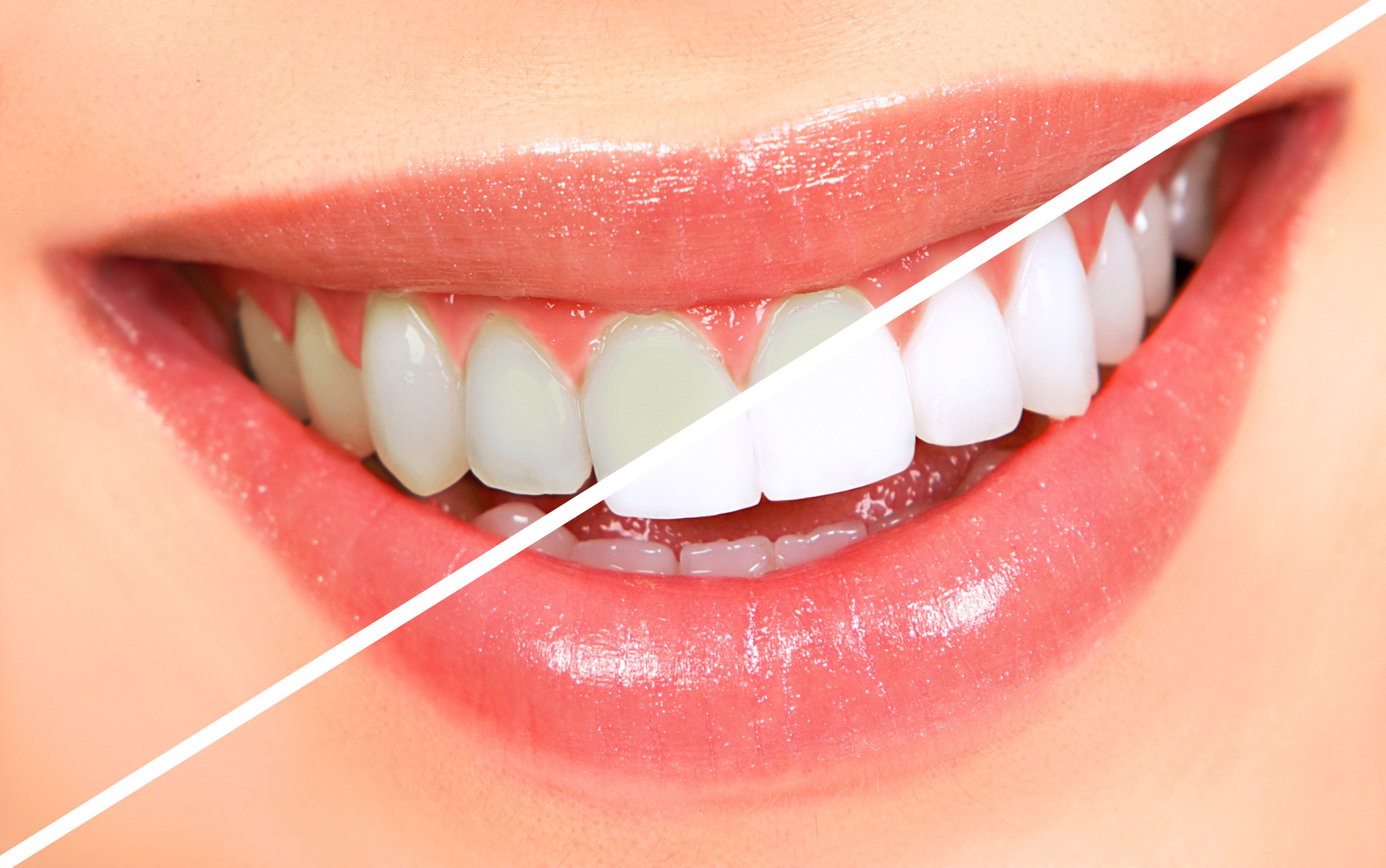 Professional teeth whitening service at Whiteberry Dental Clinic