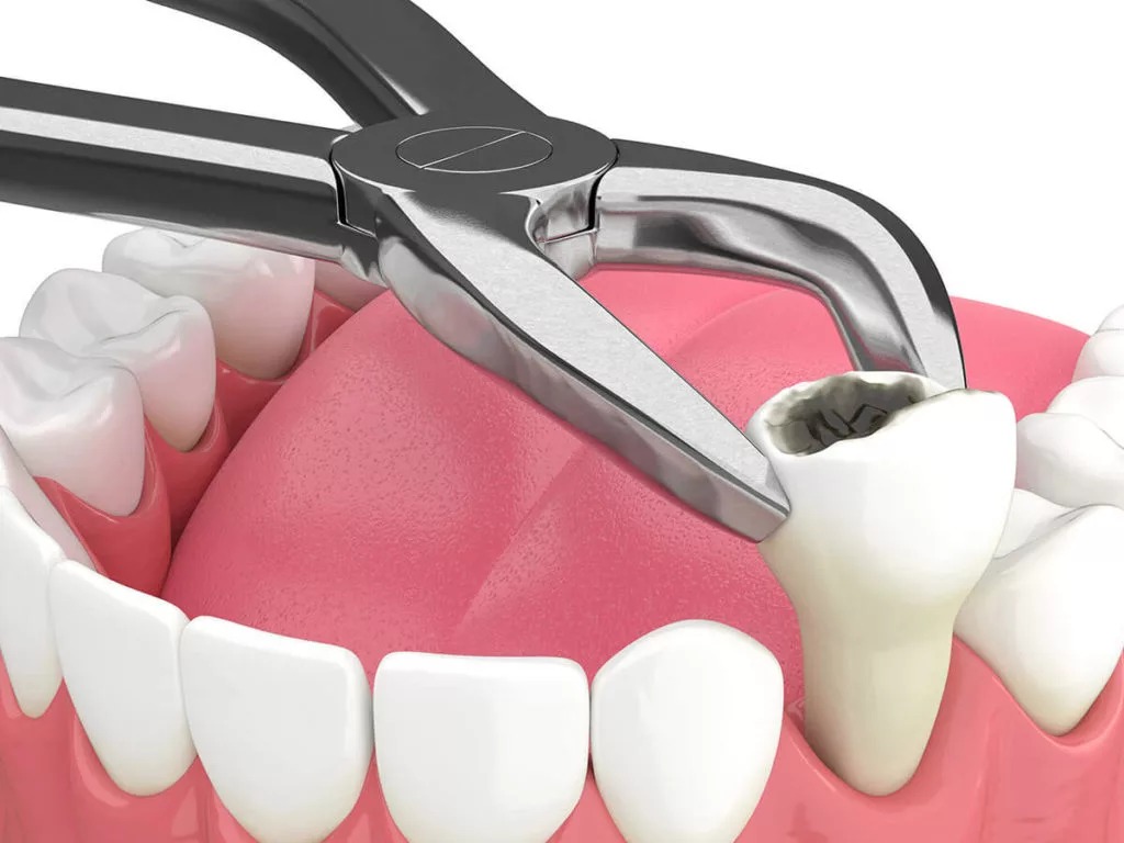 Tooth extraction service at Whiteberry Dental Clinic