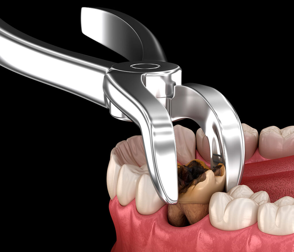 Dental evaluation before extraction
