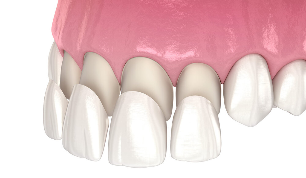 Dental veneers consultation at Whiteberry