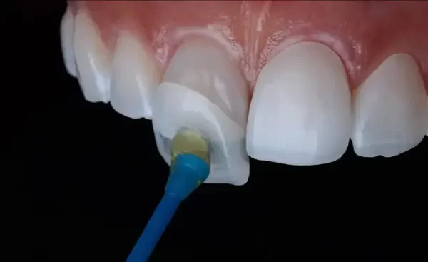 Veneers treatment at Whiteberry Dental Clinic