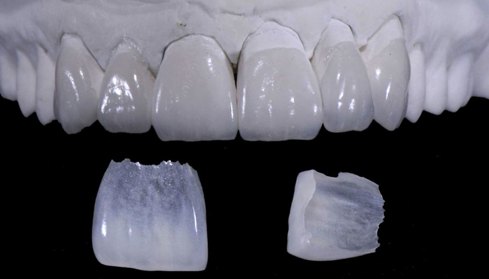 Custom veneer preparation
