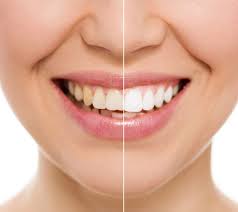 Whitening treatment